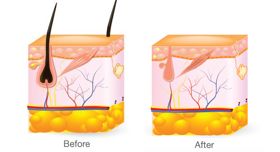 Before and after IPL